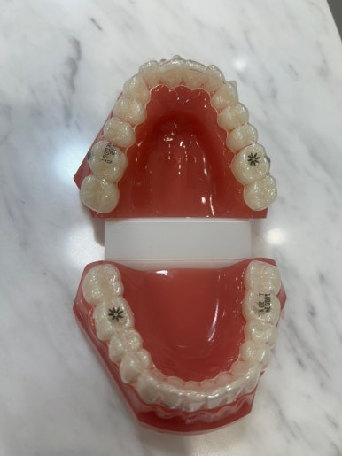 시청역, 서울역,광화문역 외국인도 찾는 투명교정 브랜드 인비절라인이벤트 가격공개! 관련 이미지 12