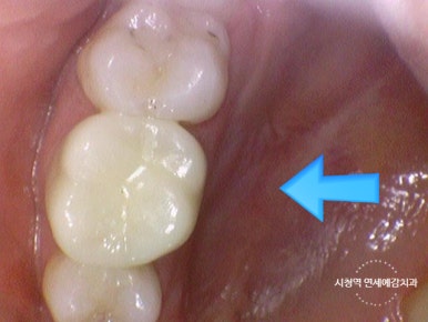 신경치료 끝났는데 크라운 해야하나요? 자연스러운 지르코니아 크라운 유명한 치과 가격까지 관련 이미지 8