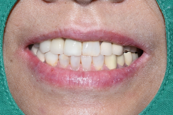 [시청역/서울역]네비게이션인플란트를 이용한 여러개 임플란트 과정 관련 이미지 12