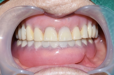 남대문시장가까운치과, 명동,서울역&용산가까운치과, 틀니치료 사례 관련 이미지 21