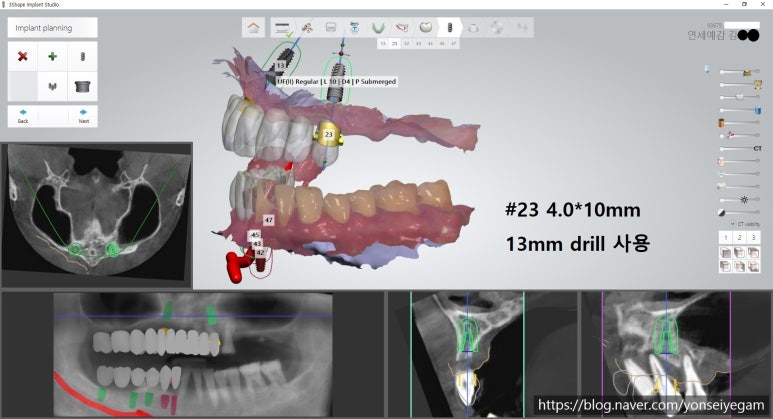 서울역 가까운 치과 시청역치과 연세예감 임플란트 네비게이션임플란트로 다수 임플란트도 빠른수술과 부작용최소화 관련 이미지 6