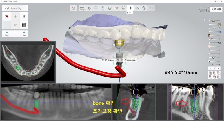 [북창동 치과/연세예감치과]내비게이션임플란트소개 관련 이미지 6