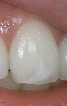 [시청역/치과] 화이트스팟, 반점치 앞니 치료 케이스 관련 이미지 2