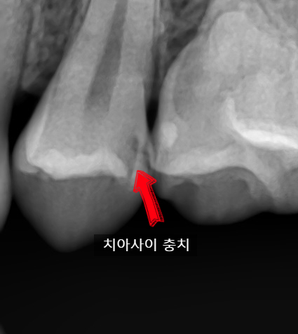 충정로 치과 인레이 해야한다고 들었는데 충치가 안보여요 관련 이미지 4