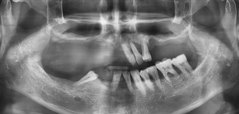 사용중인 틀니가 불편하다면? 임플란트와 틀니가 결합된 임플란트 틀니 추천 관련 이미지 18