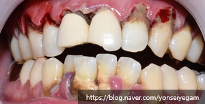Q&A) 치아가 간지러워요 관련 이미지 5