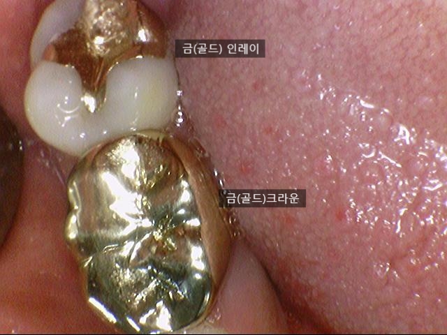 연세예감치과에서 알려드리는 심미적이고 기능적으로도 우수한 e-max인레이 치료 관련 이미지 1