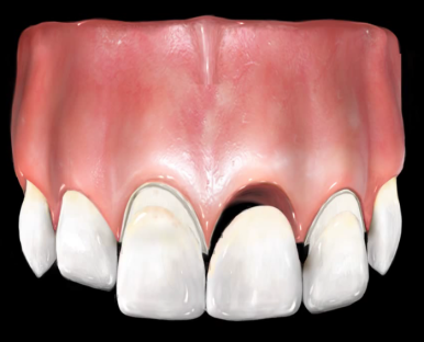 서울시청역 남대문 임플란트 대신에 앞니 브릿지를 한 케이스 관련 이미지 2