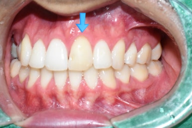 [광화문/치과] 외국인환자 변색된 앞니 하나의 크라운 치료 실제 케이스 관련 이미지 2