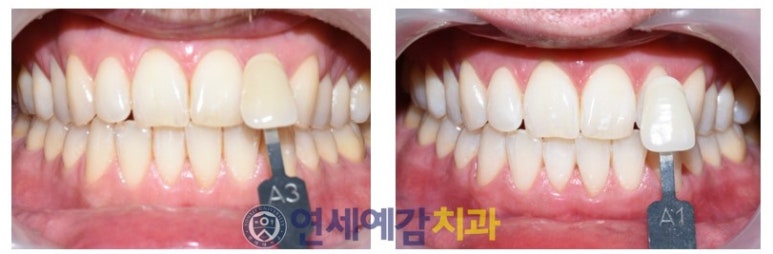 [광화문]해외에서도 찾아오는 원데이치아미백/이벤트가격/실제사례 관련 이미지 4