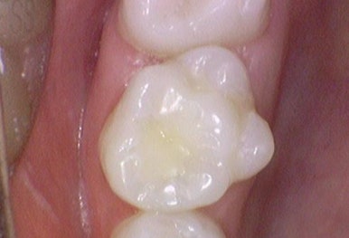 시청역 충정로 충치치료 치과 추천 관련 이미지 6