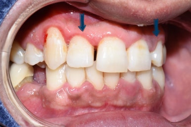 1.송곳니를 다른 앞니 모양 라미네이트로, 2.치아사이 빈공간을 라미네이트로 관련 이미지 1