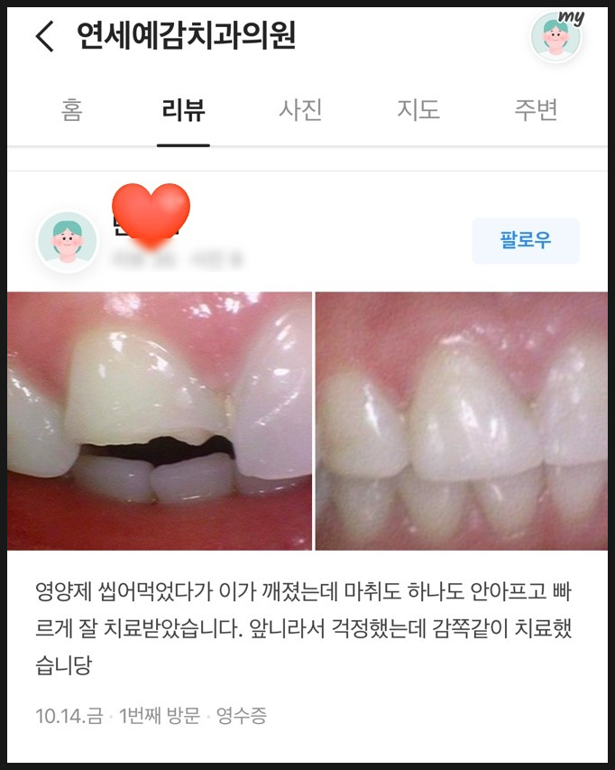 [시청역/서울역 치과] 앞니 치아부러짐 자연스럽게 치료사례 관련 이미지 10