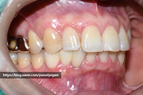 벌어진 앞니 교정치료 & 오래된 앞니 브릿지 다시하기 관련 이미지 9