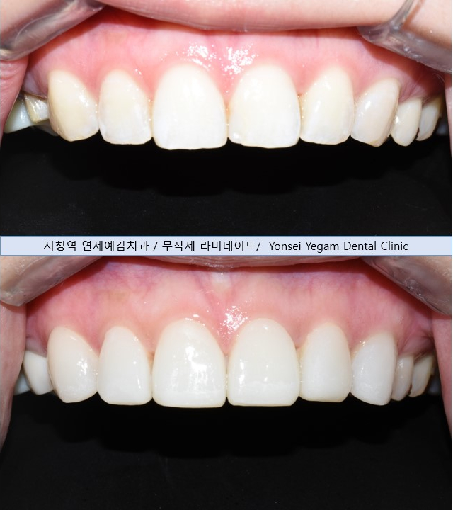 VENEER in Seoul, Korea/ Cost, Cases(before&after photos)/ YONSEI YEGAM DENTAL CLINIC 관련 이미지 12