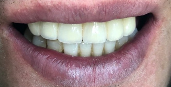 [시청역/서울역 치과] 앞니 치아부러짐 자연스럽게 치료사례 관련 이미지 9