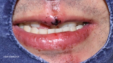 넘어져서 또는 부딪혀서 앞니 아주 많이 부러진 경우, 시청역치과 실제 앞니브릿지케이스 관련 이미지 13
