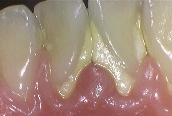 [남대문/시청역/광화문]당일 스케일링가능한 치과? 관련 이미지 1