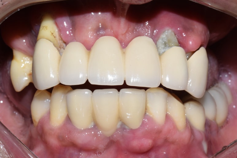 [임플란트/서울역] 서울 상악 전체인플란트 실제사례.극한의 케이스도 관련 이미지 3