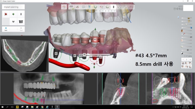 [남대문시장] 임플란트 조금 더 안아프고 간편하게 관련 이미지 11