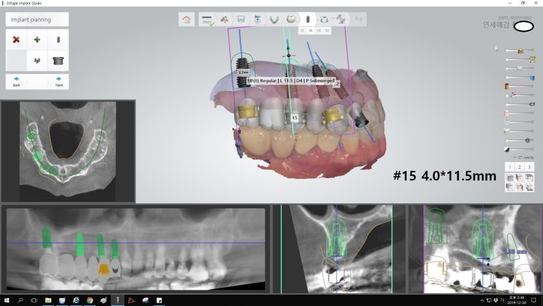 [북창동 치과/연세예감치과]내비게이션임플란트소개 관련 이미지 21