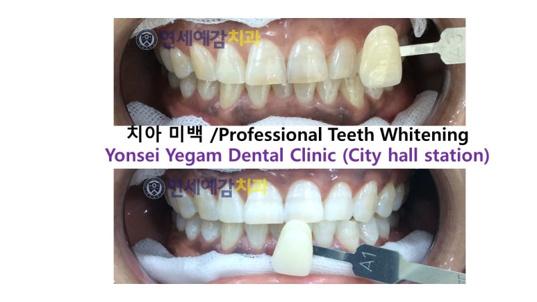 서울 시청역/서소문 스켈링은? <시청역 치과 연세예감치과> 관련 이미지 9