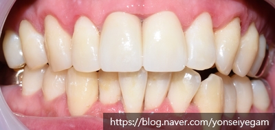 잇몸질환 평생 걱정안합니다??? 관련 이미지 5