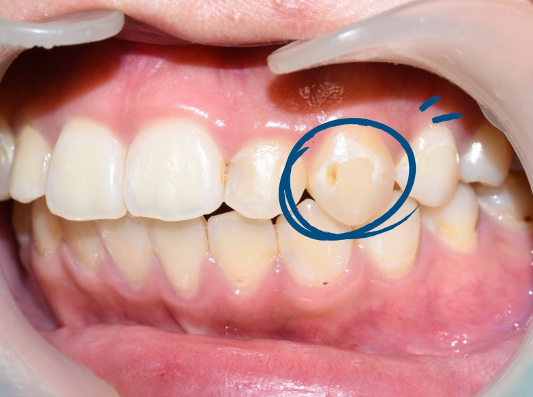 [서울역/시청역] 충치 & 화이트 스팟 (반점치) 의 레진치료케이스 관련 이미지 5