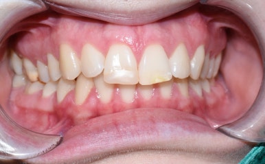 왜소치 치아사이틈 막기 올해는 치료받으세요! [무삭제라미네이트 케이스] 관련 이미지 9