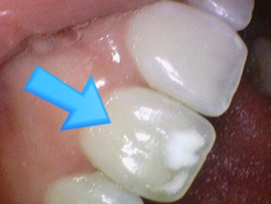 [서울 광화문/남대문] 화이트스팟 레진으로 치료케이스, 비용안내 등등 / 반점치, 반상치 관련 이미지 2