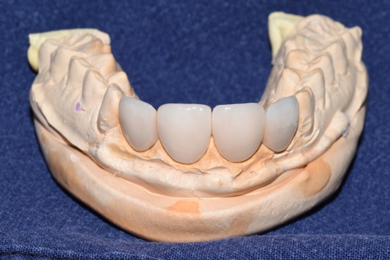 [서울역/을지로/치과] 본인이 옥니라고 생각한다면? 무삭제 라미네이트 어떤가요? 케이스 및 가격비용 관련 이미지 4