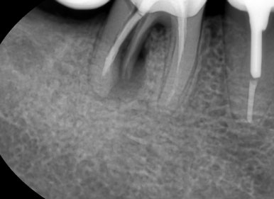 [서울역/치과] 고기 뼈를 씹고 치아가 부러졌어요 관련 이미지 10