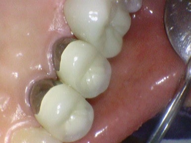 금크라운을 치아색 지르코니아 교체? 또는 크라운이 빠져서 새크라운?  광화문 시청역 서울역 치과, 가격까지! 관련 이미지 3