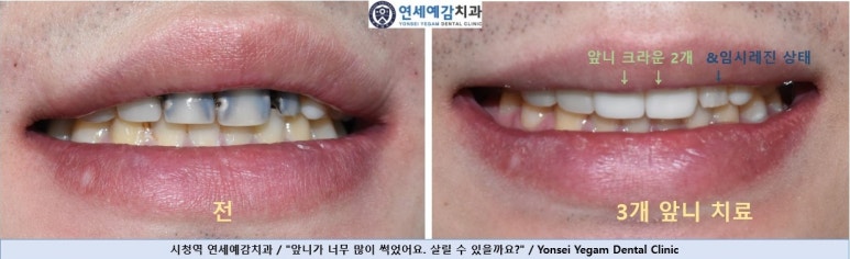 시청역치과 치아가 부러졌어요 치아가 너무 많이 썩어서 앞니가 거의 없는 치아의 크라운 케이스 관련 이미지 7