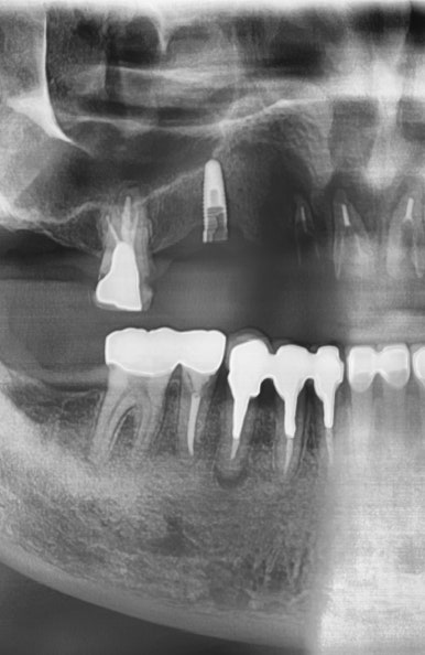 오래된 임플란트가 흔들려요 인플란트 재수술도 서울역가까운치과 연세예감치과 관련 이미지 4