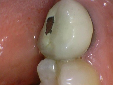 금크라운을 치아색 지르코니아 교체? 또는 크라운이 빠져서 새크라운?  광화문 시청역 서울역 치과, 가격까지! 관련 이미지 4
