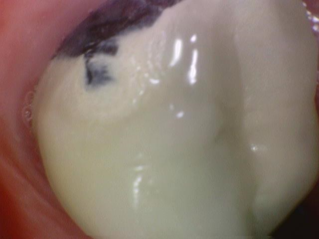 광화문 연세 예감 치과 해외에서도 찾아오는 지르코니아크라운 치료 안내해드려요 관련 이미지 17