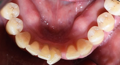 시청역 앞니교정 알아보겠습니다![실제 사례:앞니 하나가 점점 튀어나오고 벌어져요] 관련 이미지 5