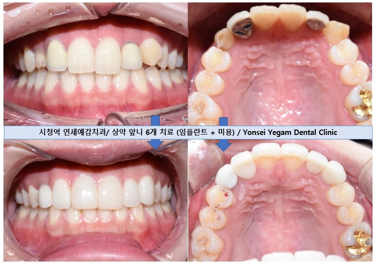 [광화문/시청역 치과]임플란트+크라운 +무삭제 라미네이트 복합 혼합 "6개 앞니 케이스" 소개/라미네이트가격 관련 이미지 6
