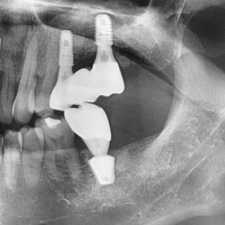 [서울시청역치과] 다른 치과에서 오래전에 한 임플란트가 흔들려요 &rarr;재수술 케이스 관련 이미지 12