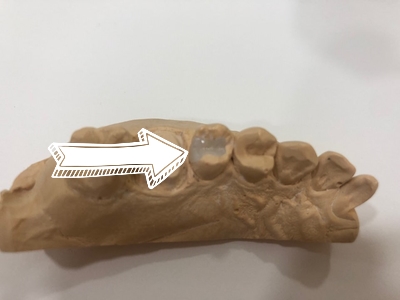 연세예감치과에서 알려드리는 심미적이고 기능적으로도 우수한 e-max인레이 치료 관련 이미지 2