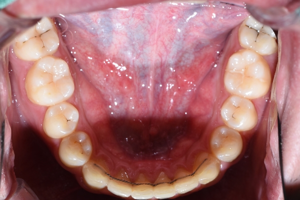 시청역치과 심한 (앞니)충치 치료방법 전후 사례 살펴보아요 관련 이미지 4