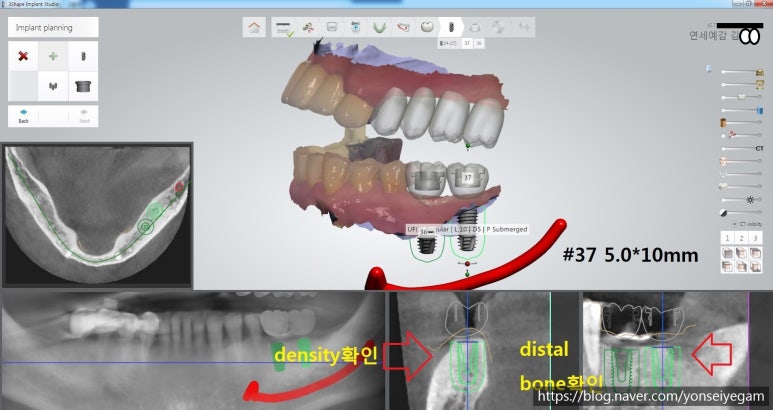 서울역 가까운 치과 시청역치과 연세예감 임플란트 네비게이션임플란트로 다수 임플란트도 빠른수술과 부작용최소화 관련 이미지 2
