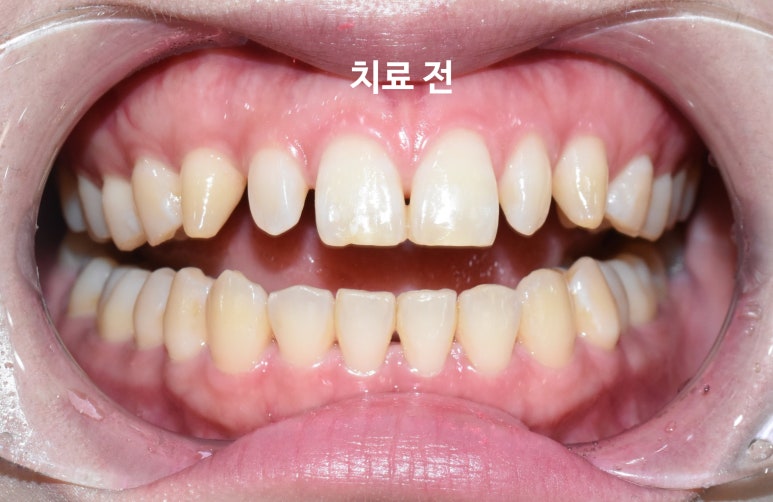 서울 시청역/서울역/ 벌어진 앞니, 왜소치 라미네이트 유명한 치과/ 전후 비교와 가격 관련 이미지 4