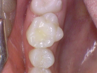 시청역치과추천 겁이 많은 치과공포증 어른들도 찾아오는 치과 여자원장님 진료 관련 이미지 16