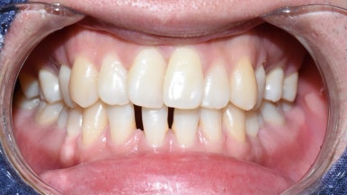 해외에서도 찾아오는 앞니레진치료, 광화문 시청역 서울역 근처 연세예감치과 외국인도 찾는 이유 관련 이미지 9