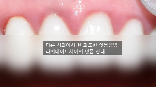 라미네이트 후 잇몸 괜찮을까요? & 라미네이트를 다시 제거하고 원래 치아상태로 쓸 수 있나요? 관련 이미지 1