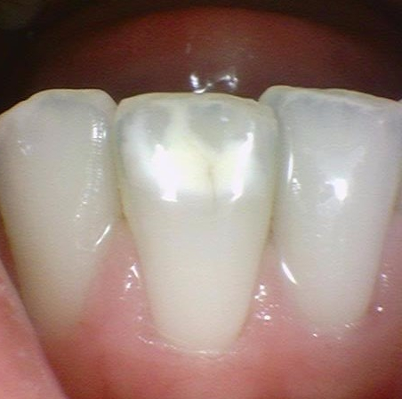 [서울역/시청역] 레진치료 : 화이트스팟(반상치) 케이스 & 치아패임으로 시린 케이스 & 깨진 치아 케이스 관련 이미지 5