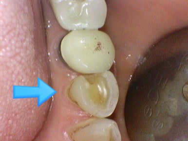 시청역 충정로 충치치료 치과 추천 관련 이미지 11