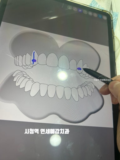 투쓰젬(Tooth gem),굳이 한다면 꼭 치과에서! 이유&비용,실제 치과에서 한 사진까지! 관련 이미지 5